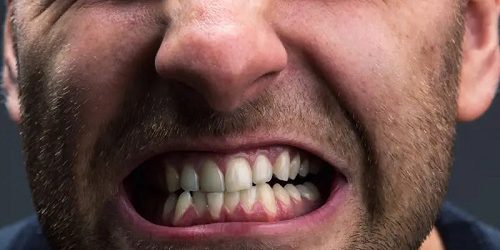 اگر بریس دارید، قبل از استفاده از محافظ دندان قروچه حتماً این نکات را بدانید!