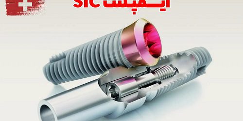 ایمپلنت SIC سوئیس؛ سرمایه‌گذاری برای یک لبخند ماندگار، نه فقط کاشت دندان