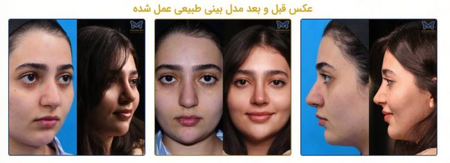 عمل بینی طبیعی چگونه به ایجاد تناسب بیشتر چهره کمک می کند؟