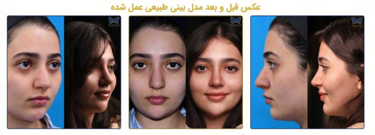 عمل بینی طبیعی چگونه به ایجاد تناسب بیشتر چهره کمک می کند؟