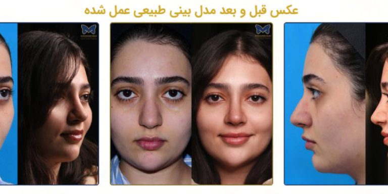 عمل بینی طبیعی چگونه به ایجاد تناسب بیشتر چهره کمک می کند؟