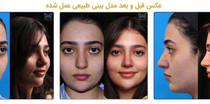 عمل بینی طبیعی چگونه به ایجاد تناسب بیشتر چهره کمک می کند؟