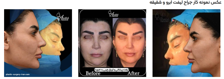 کبودی بعد ازجراحی لیفت صورت