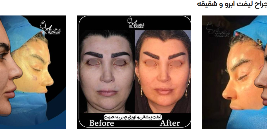 کبودی بعد ازجراحی لیفت صورت
