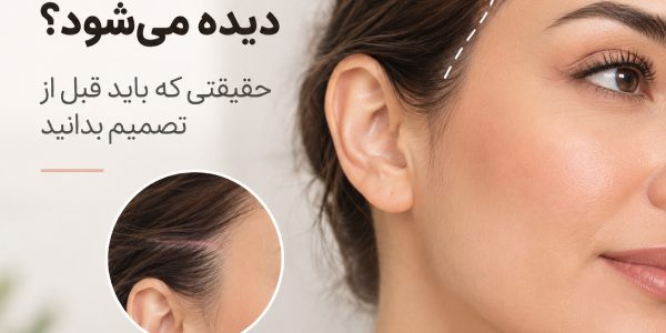 جای برش لیفت شقیقه دیده می‌شود؟ حقیقتی که باید قبل از تصمیم بدانید