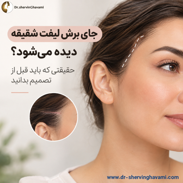 جای برش لیفت شقیقه دیده میشود؟ حقیقتی که باید قبل از تصمیم بدانید جای برش لیفت شقیقه دیده میشود؟ حقیقتی که باید قبل از تصمیم بدانید