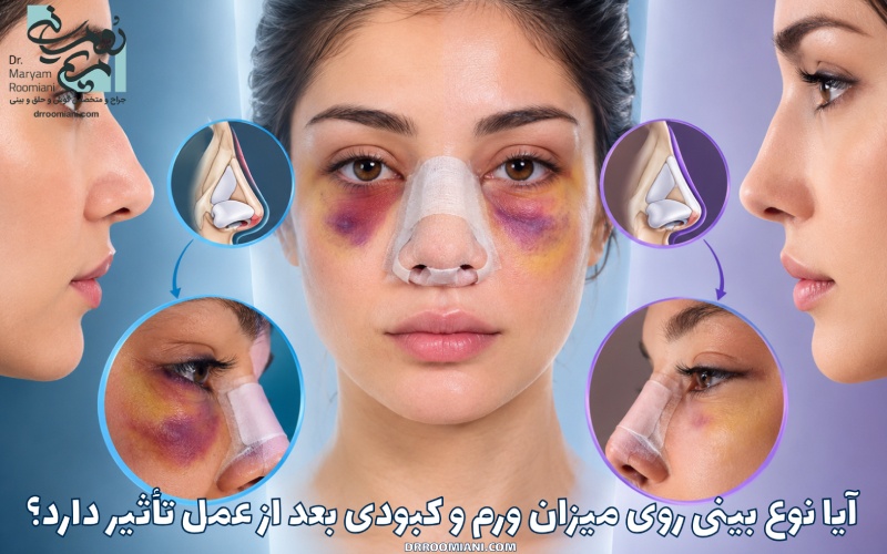 آیا نوع بینی روی میزان ورم و کبودی بعد از عمل تأثیر دارد؟