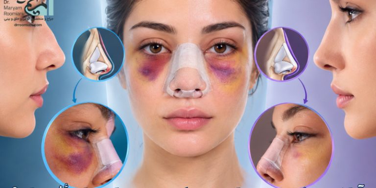 آیا نوع بینی روی میزان ورم و کبودی بعد از عمل تأثیر دارد؟